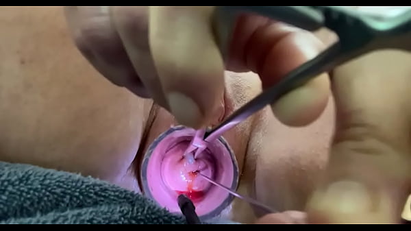 rosebud fucks uterus while tenaculum pulls traction